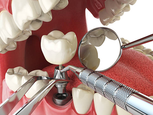 Best Emergency Tooth Extraction in Lake Murray Of Richland, SC